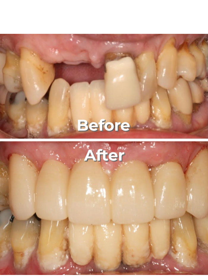 Smile Gallery – Premier Dental